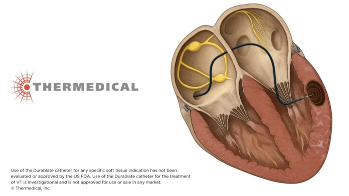 Saline Enhanced Radiofrequency (SERF) Ablation System with the Durablate® Catheter